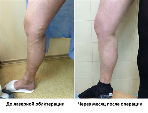 Комплексное лечение варикозной болезни в Волгограде